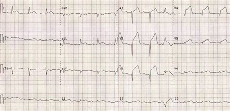 Anterior Myocardial Infarction • LITFL • ECG Library Diagnosis