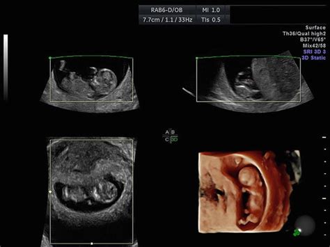 Ultrasound in the First Trimester and Earlier: How to Keep It Safe ...