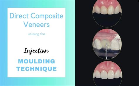 Direct Composite Veneer Utilising the Injection Moulding Technique ...