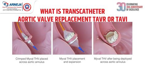 What is Transcatheter Aortic Valve Replacement TAVR OR TAVI? - Arneja ...