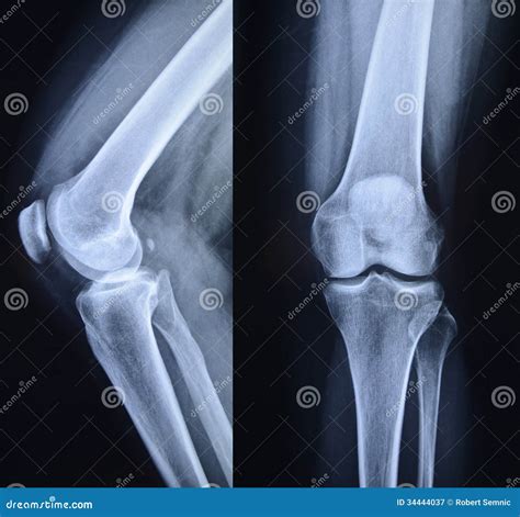 Días laborables gatito grado radiografia de rodilla izquierda normal ...