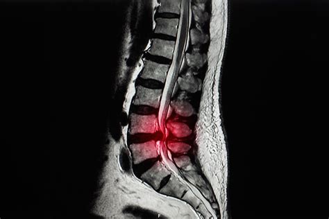 Estenosis de Canal Lumbar | Patología de Columna Vertebral