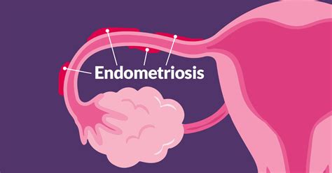 How To Detect Endometriosis - Endometriosis: Symptoms, diagnosis, and ...