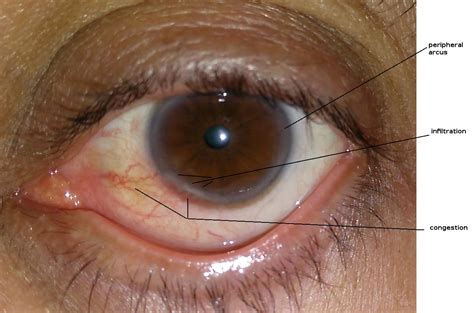 eye - Recurrent inflammation at edge of cornea - Medical Sciences Stack Exchange