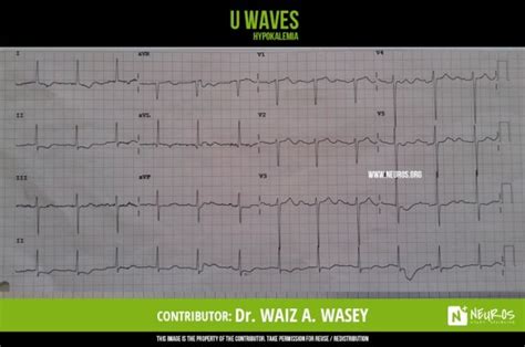 U waves | Neurology nursing, Medical, Social networks