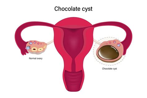 Understanding Chocolate Cysts: Causes, Symptoms, and Treatment