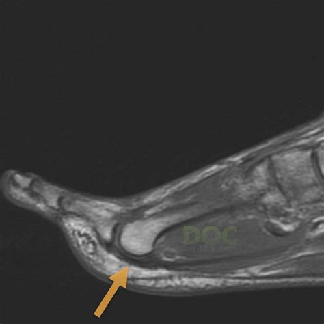 What is thinning of the plantar plate ligament on MRI? - Doc On The Run Podcast | Ximalaya ...