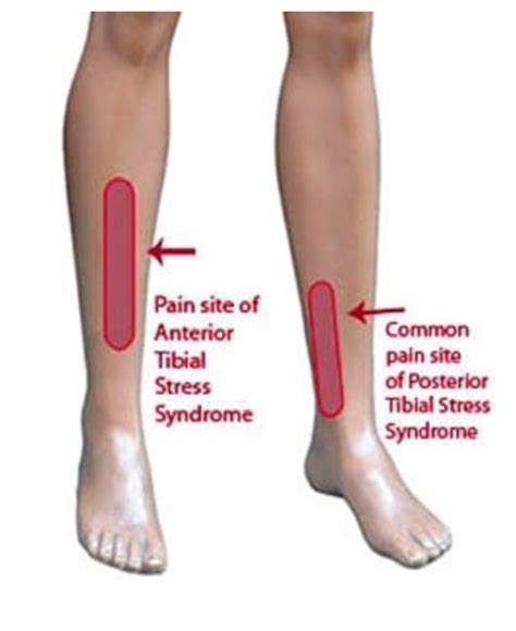 Recognition, treatment and therapy for painful shin splints — Fit For Life