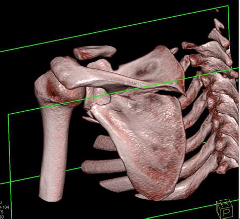 Scapular Fracture s/p Trauma - Musculoskeletal Case Studies - CTisus CT Scanning