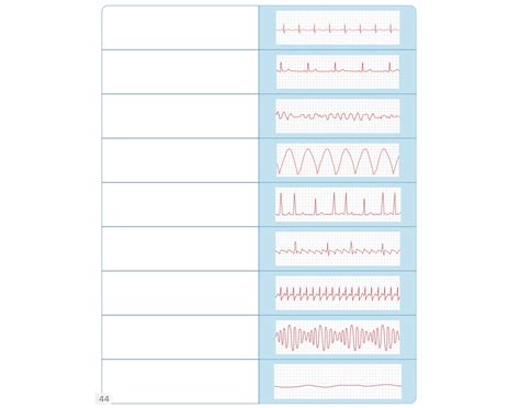 EKG STRIPS - NURSING Quiz