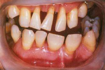 Gum Disease - body, causes, What Is Gum Disease?