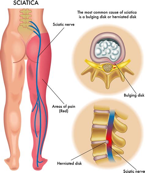 Epidural Steroid Injection, Temecula Pain Doctor, sciatic Pain Doctor