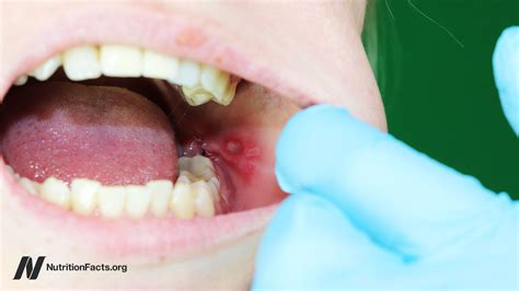 What Causes Canker Sores and How to Get Rid of Them