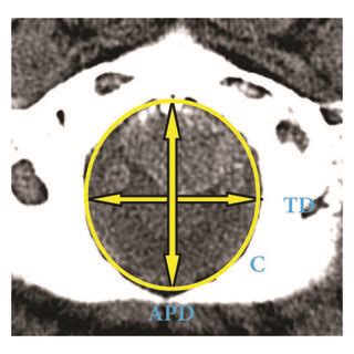 Cranial base demonstrating the foramen magnum measurements. | Download ...