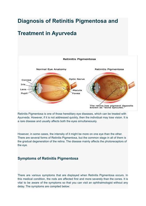 PPT - retinitis pigmentosa treatment in ayurveda PowerPoint Presentation - ID:11451599