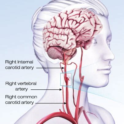 Transient Ischemic Attack (TIA) | American Stroke Association