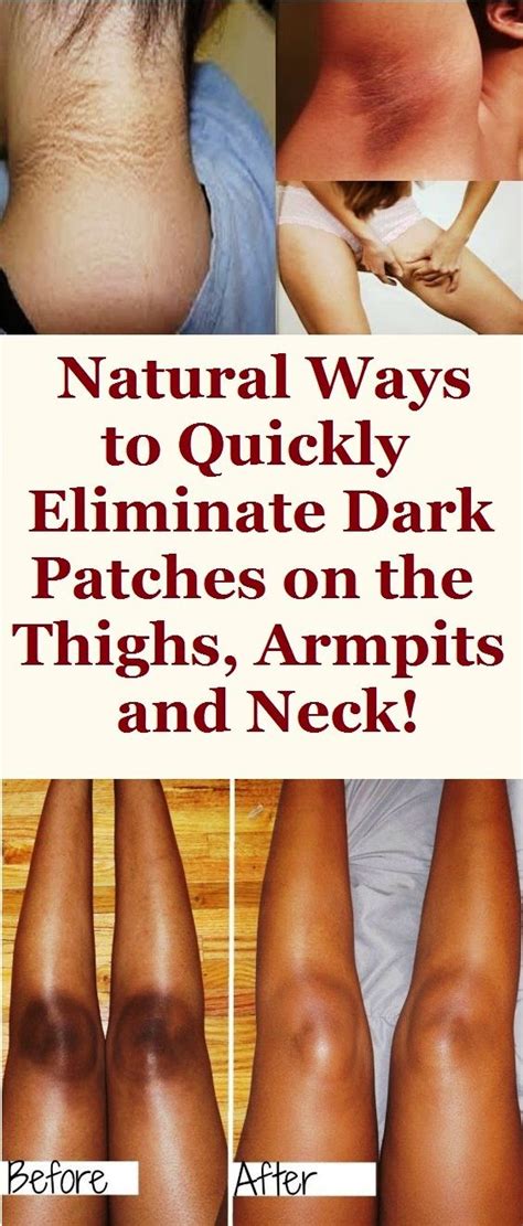 DIY: HOW TO REMOVE DARK PATCHES ON THE NECK, THIGH AND UNDER ARM. - TOP 5 DIY