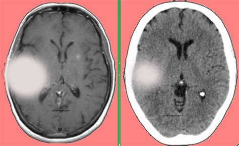 Brain Tumor Headache Symptoms Treatments Causes