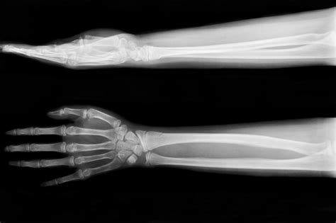 Premium Photo | X-ray fracture ulnar bone (forearm bone)