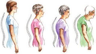 How to treat hunchback (and what causes it to begin with) - Life Care Chiropractic and Wellness ...