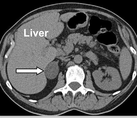 Adrenal Incidentaloma: Adrenal Tumor Found by Accident