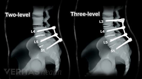 Multilevel Spinal Fusion for Low Back Pain