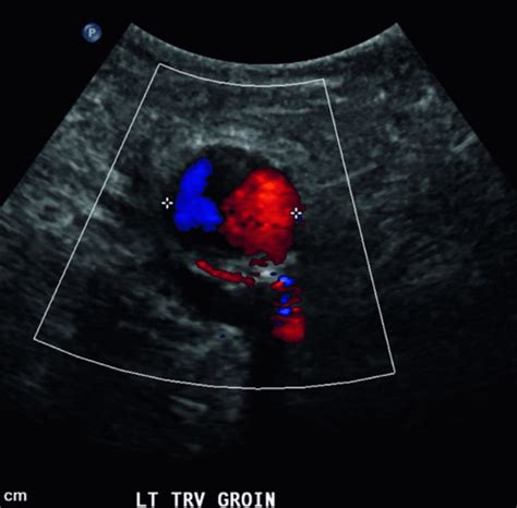 Vascular Access Complications | Thoracic Key