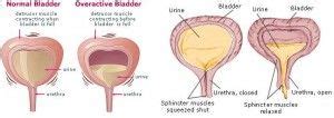 spastic bladder (aka neurogenic bladder). Perform intermittent catheterization for residual ...