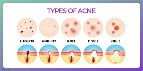 ACNE - Symptoms, Causes, Complications, and Treatment - Ecosh