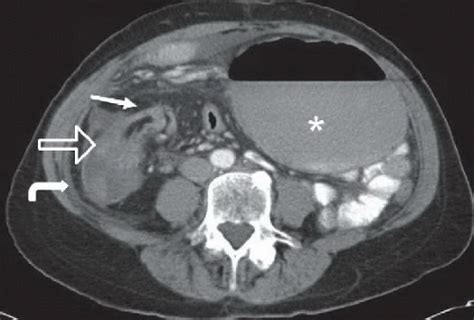 Cecal Volvulus | Radiology Key