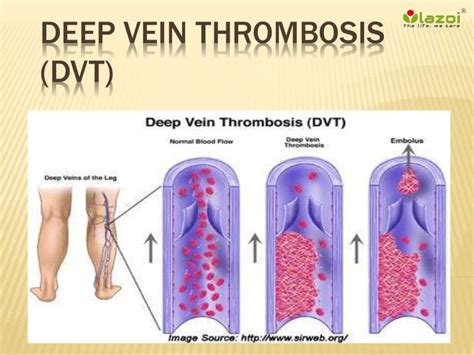 Deep vein thrombosis dvt