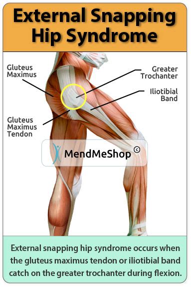 Snapping Hip Syndrome Information and Treatments