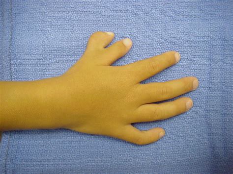 Birth: Polydactyly