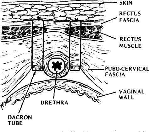 The stamey endoscopic bladder neck suspension | Semantic Scholar