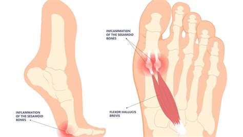 Sesamoiditis | Sesamoiditis Treatment and Diagnosis