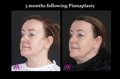 Pinnaplasty – Ear reshaping for prominent ears – A M Aesthetic Surgery