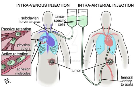 Intra-arterial immunotherapy by Kezhound on DeviantArt