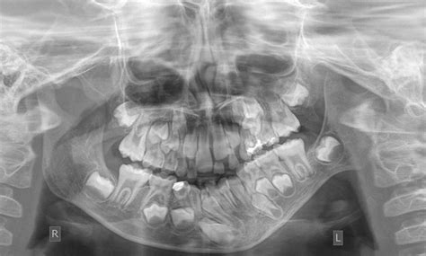 Distraction Osteogenesis (Osteodistraction) | Hellenic Craniofacial Center