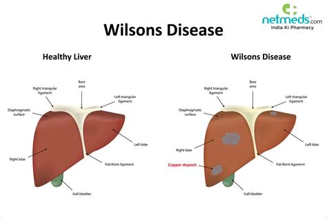 Wilson’s Disease: Causes, Symptoms And Treatment | Netmeds