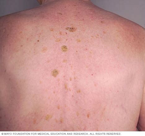 Seborrheic keratosis Disease Reference Guide - Drugs.com