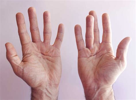 Dupuytren's contracture - Causes, Diagnosis and Treatment