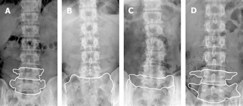 Anteroposterior lumbar radiographs with diagrams overla | Open-i