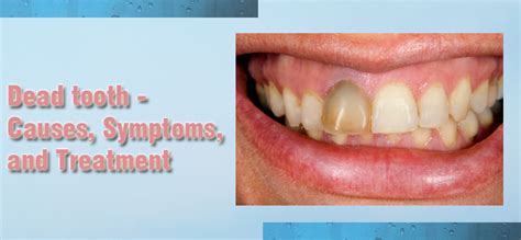 Dead Tooth : Causes, Symptoms, and Treatment