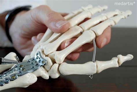 Wrist Fusion Surgery | Ladan Hajipour Orthopaedic Surgeon