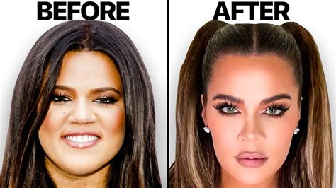 Khloe Kardashian NEW Face | Plastic Surgery Analysis - Oasis Medical Aesthetics