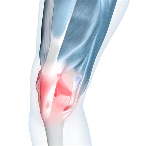 Types Of Knee Tendonitis Sale Websites, Save 66% | jlcatj.gob.mx