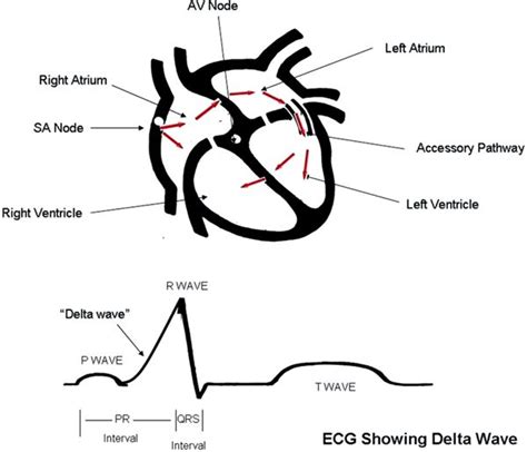 Wolff-Parkinson-White Syndrome (WPW) – Paces