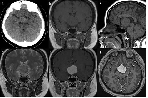 Third Ventricle Mri