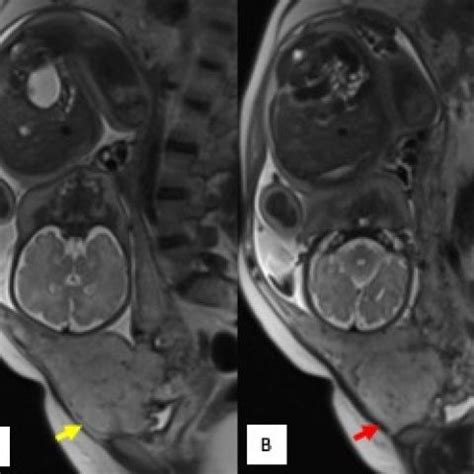 Placenta Accreta Mri