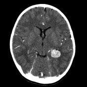 Choroid plexus papilloma | Radiology Reference Article | Radiopaedia.org